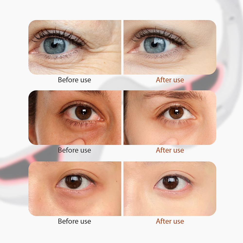 Red Light EMS Eye Massager for Dark Circles & Wrinkles