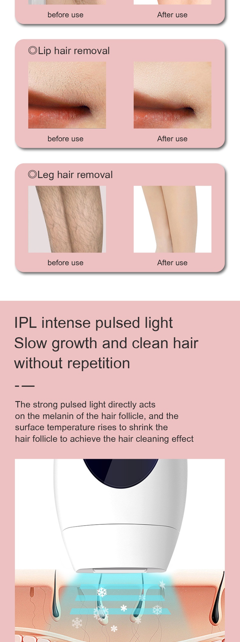 Épilation laser IPL indolore, technologie de congélation par point de congélation, plus de 990&nbsp;000 flashs