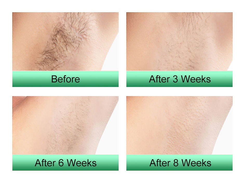 IPL Hair Removal Handset, Permanent & Painless At-Home Use