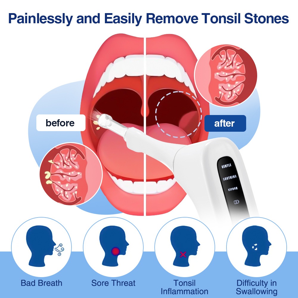 Tonsil Stone Remover with LED Light & Suction